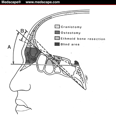 Skull Base Surgery