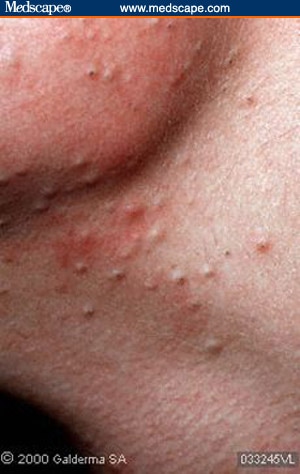 What Is Comedonal Acne and How Can It Be Treated?