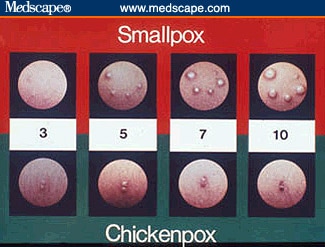 the kin lesions associated with mallpox quizlet