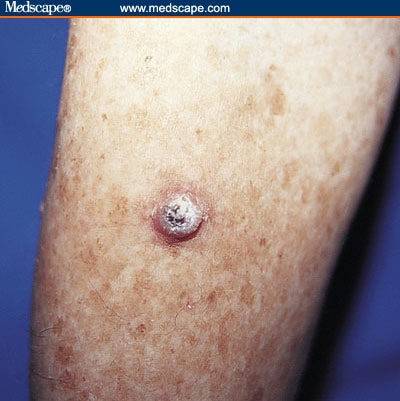skin cancers on leg #10