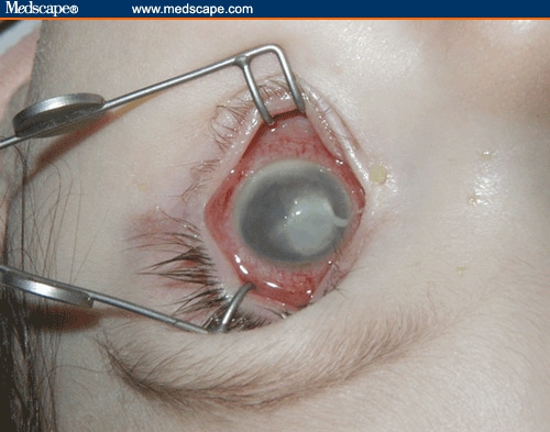  some forms of conjunctivitis that specifically affect newborn babies.