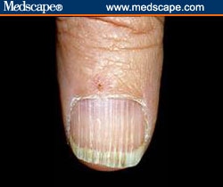When nails look sandpapered and dull, consider (Figure 12):