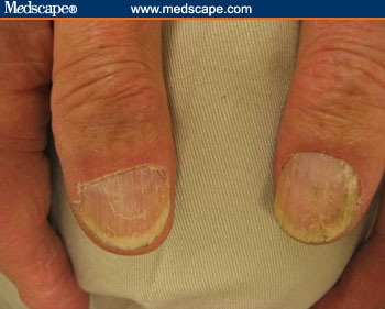 nails pathology