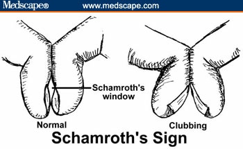 Causes of clubbing (not exhaustive) include the following (Figure 3):