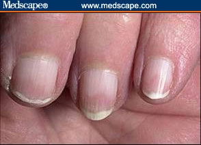 Nails Illness