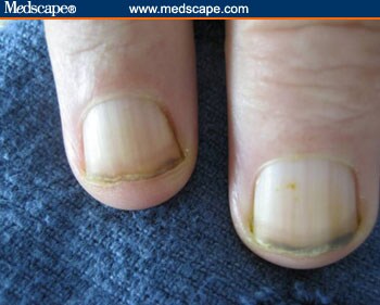 Anemia Fingernails