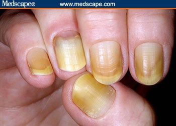 yellowish toenail