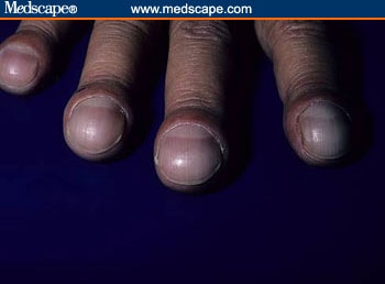 Example of clubbed fingernails