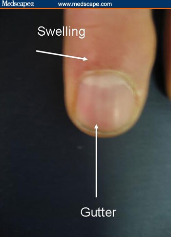 Examining the Fingernails When Evaluating Presenting Symptoms in