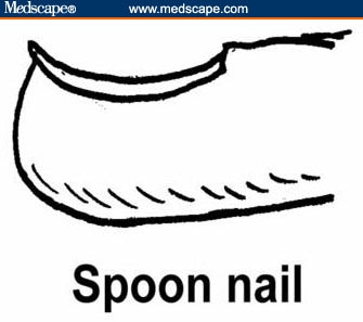 fingernails iron deficiency - MedHelp