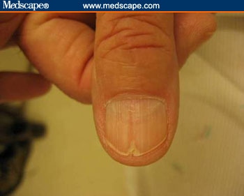 Fungal Nail Infection (Onychomycosis) Causes, Symptoms ...