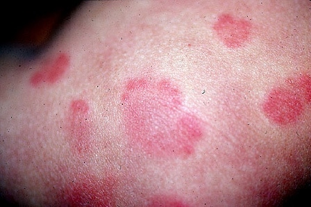 The rash was treated with hydroxyzine, and the antibiotic was changed.