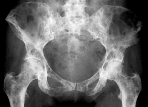 x rays of lung cancer. Typical x-ray appearance of