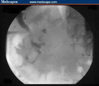 common bile duct and pancreatic duct. a normal common bile duct