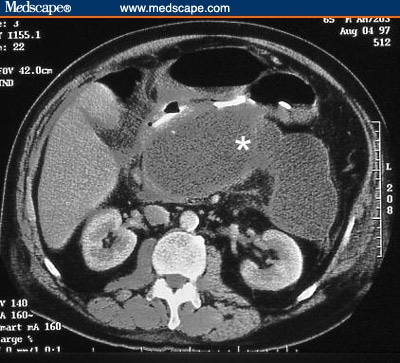 common bile duct and pancreatic duct. a normal common bile duct