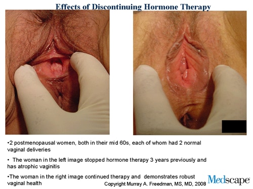 Menopause, HRT, vaginal mucus - Menopause: Menopausal ...