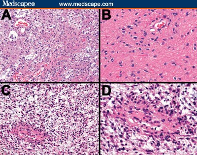 Pilocytic Astrocytoma Histology