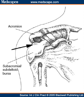 Steroid injection into shoulder bursa