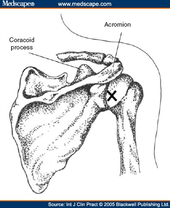Intra articular steroid injection frozen shoulder
