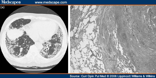 Fibroblastic Foci