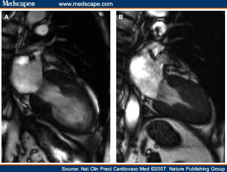 Tako tsubo cardiomyopathy prognosis