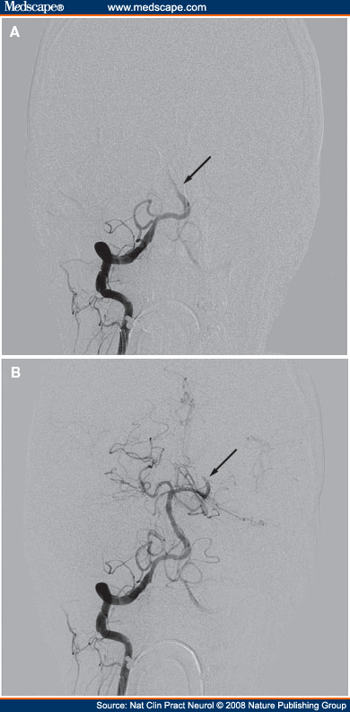 intra arterial