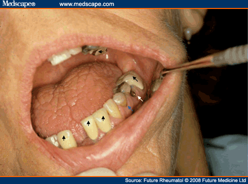 Cavity Tooth Minor