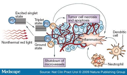 Photodynamic Therapy for Prostate Cancer Photodynamic Therapy