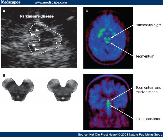 Imaging Neurodegeneration In Parkinsons Disease Imaging The Presynaptic Dopaminergic System 2026