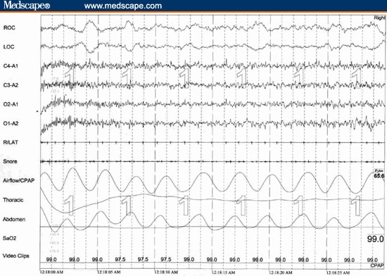 Cataplexy - Phenomenon Cataplexy - Phenomenon
