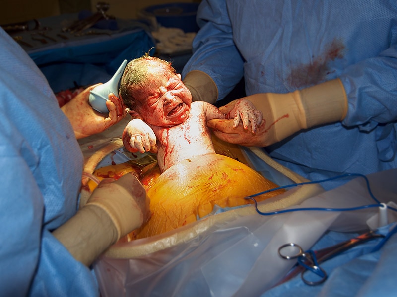 C-sections could influence babies' ability to focus 