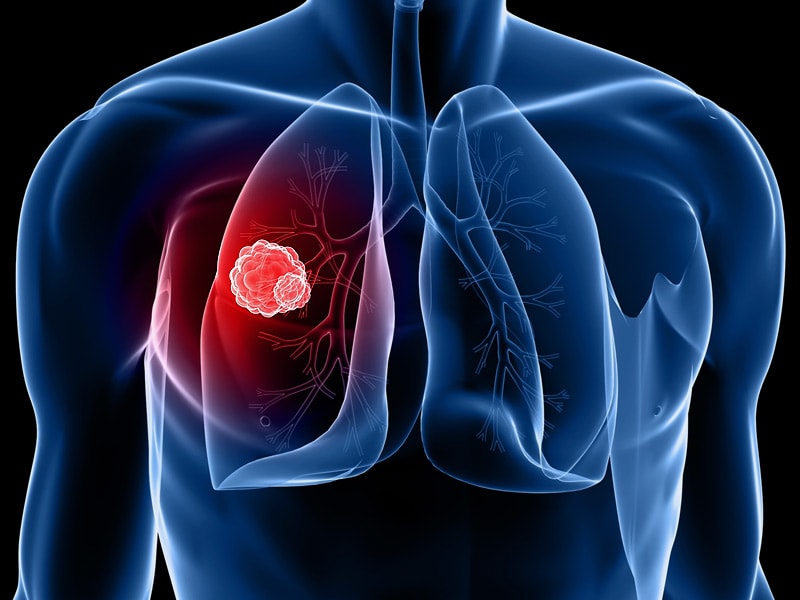 Cms lung cancer screening