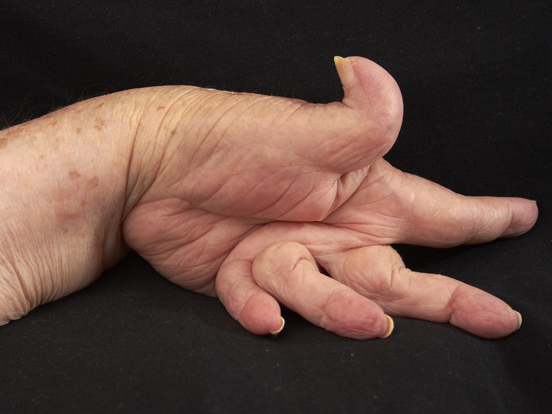 More Disease Activity in Obese Rheumatoid Arthritis Patients