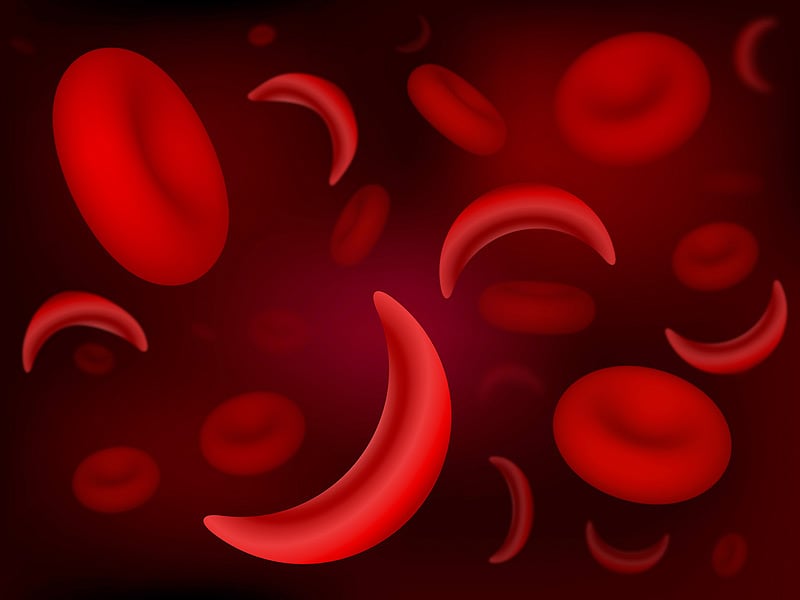 new-rapid-sickle-cell-test-based-on-red-blood-cell-density