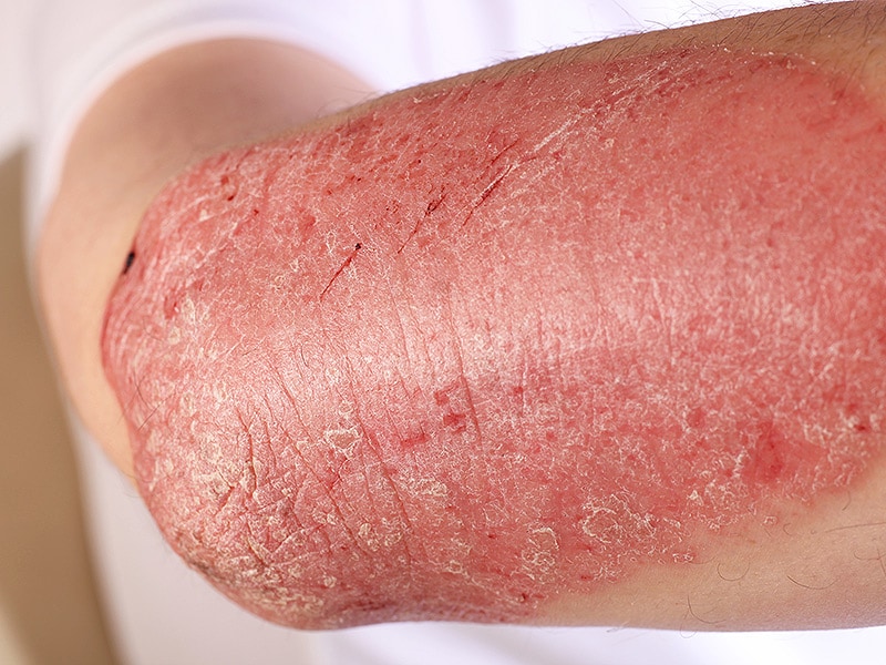 Psoriasis Types and Pictures | Psoriasis.com