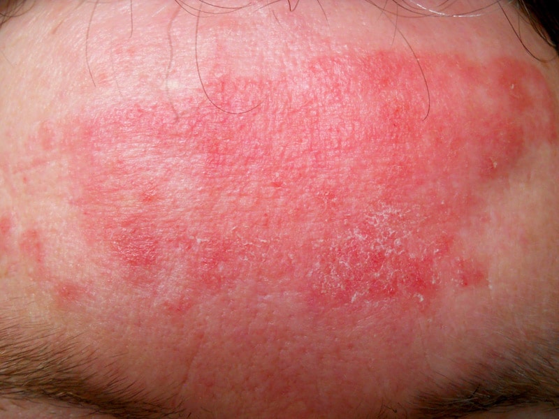 atopic dermatitis image