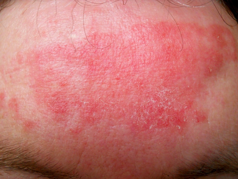 dermatitis pic