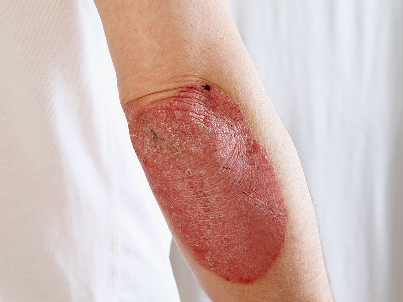 Learn about plaque psoriasis, guttate psoriasis, inverse ...