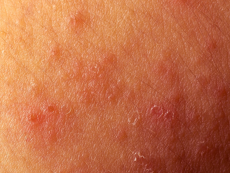 Scabies: Symptoms, Pictures, and Diagnosis - Healthline
