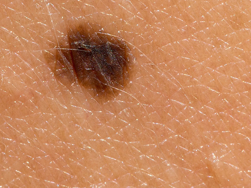 Melanoma pictures – Mole bank | SkinVision