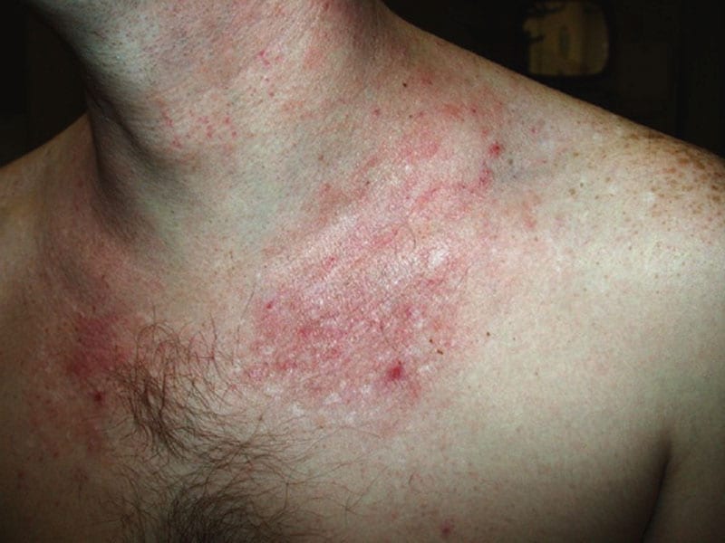 Hidradenitis suppurativa Symptoms and causes - Mayo Clinic