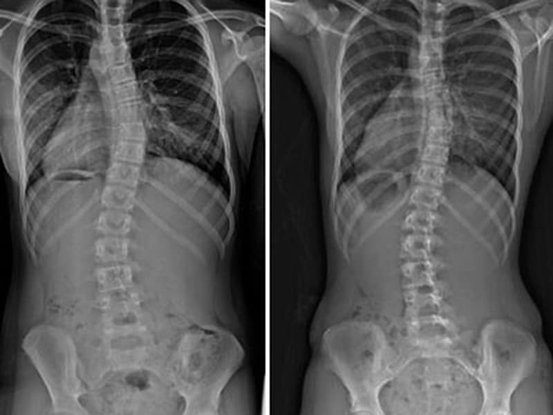 What is mild scoliosis of the thoracic spine?