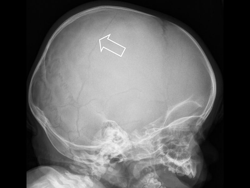 skull head fracture child children abuse survey skeletal trauma abusive medscape