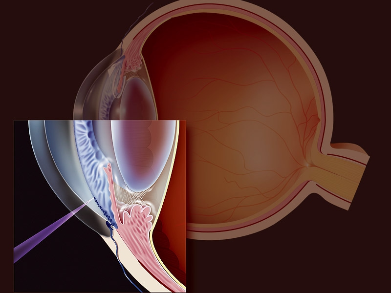 LowPower Annual SLT Effective for Ocular Hypertension