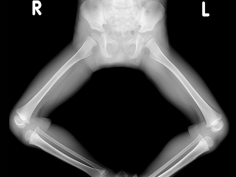 normal hip xray teen