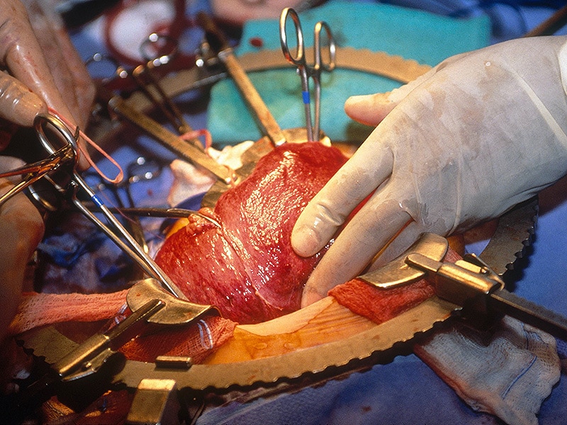 Preop Factors Affect CVD Risk After Liver Transplant