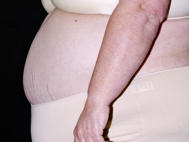 Obese Woman Pregnant 25