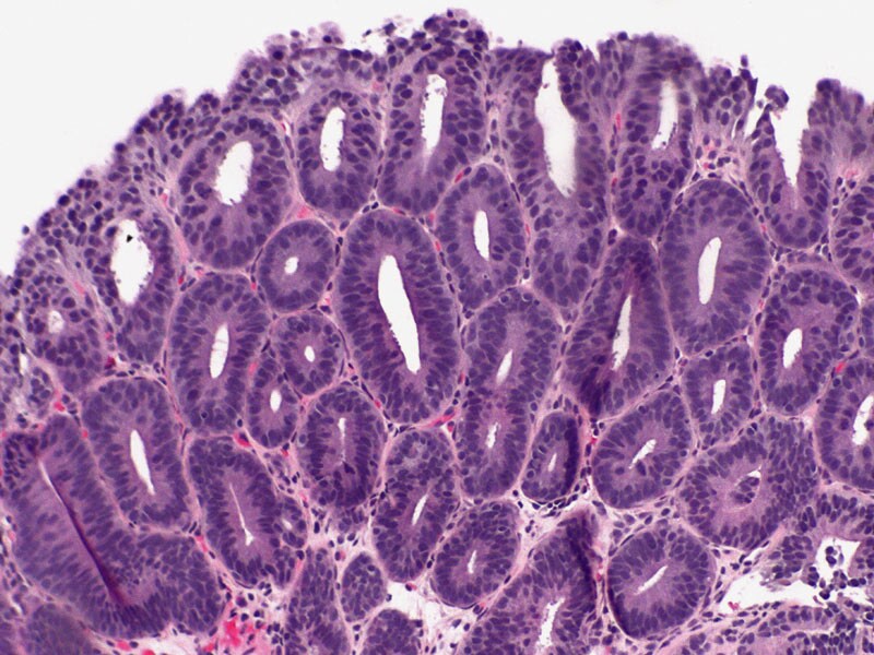 Barrett's Esophagus Firstline Endoscopic Therapy Validated