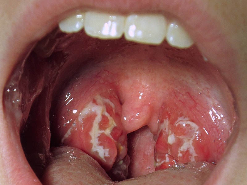 Throat Aids 65