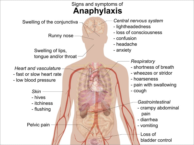 Injectable Epinephrine: An Epidemic of Misuse